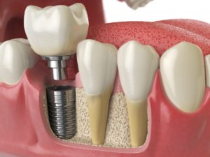 Encaixe do dente nos Implantes dentários