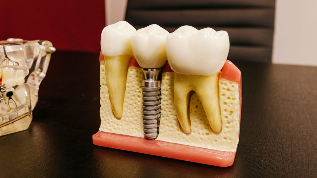 Como o dente é ficado no implantes dentário