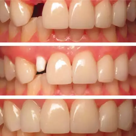 implante dentario de zirconia estetica