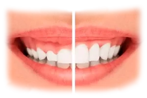 Tratamento de Gengivoplastia