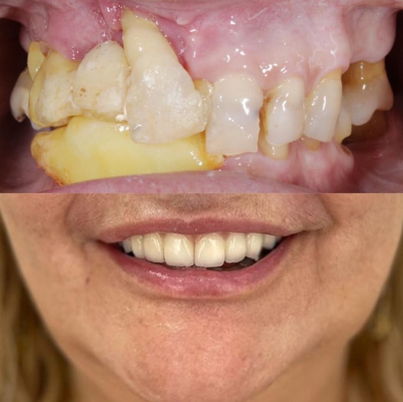 Implante de zircônia x titânio