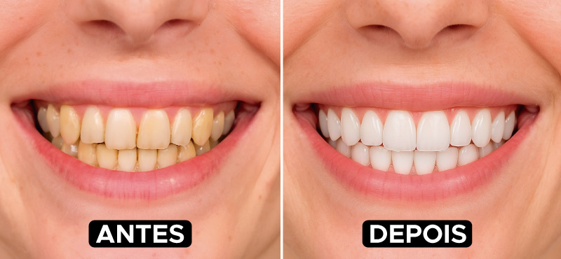 antes e depois clareamento dental em belo horizonte