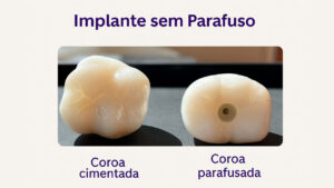 Implante Dentário sem Parafuso