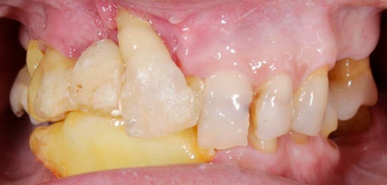 Antes da Cirurgia de Implante Dentario