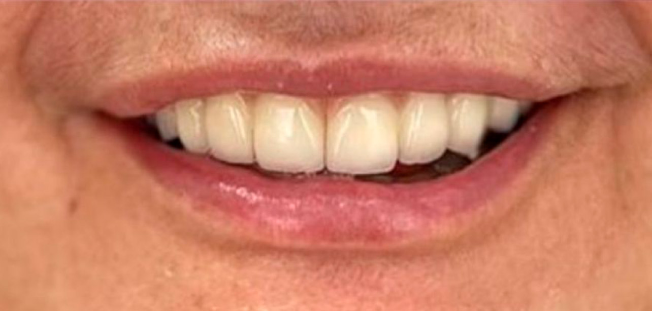 Depois da Cirurgia de Implante Dentario