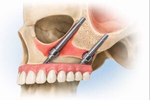 Implante Zigomatico como Funciona